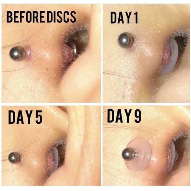 Anti Hyperplasia Anti-sagging Fixed Rings for Nose Ear Cartilage Soft Gasket