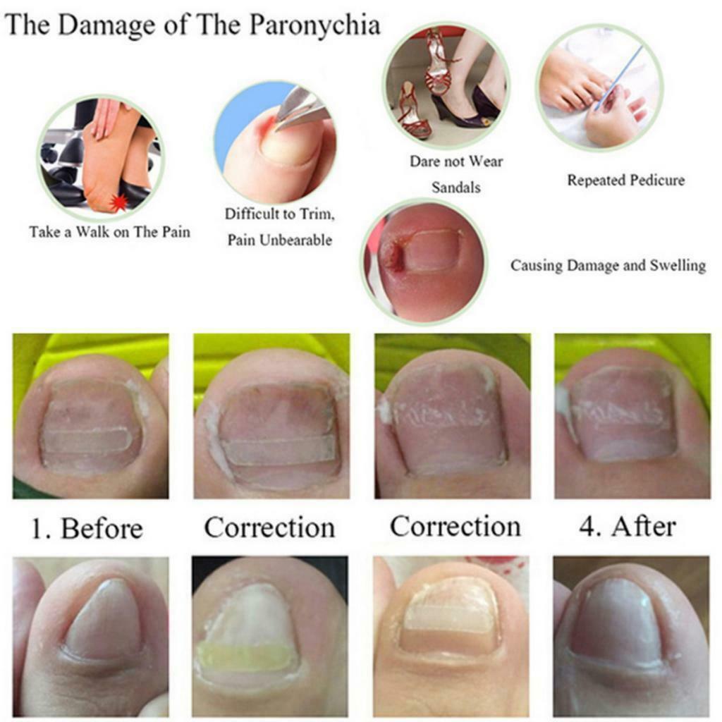 10Pcs Professional Ingrown Toenail Curved Brace Foot Care Corrector Manicure