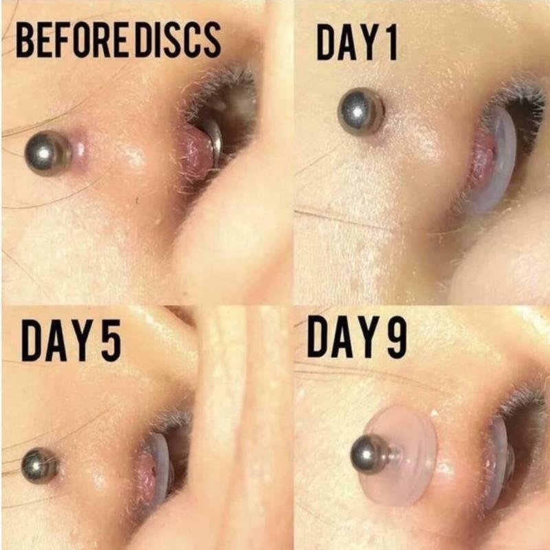 10pcs Piercing Healing Discs Anti Hyperplasia Saucer Ear Nose Gasket Tra Kt