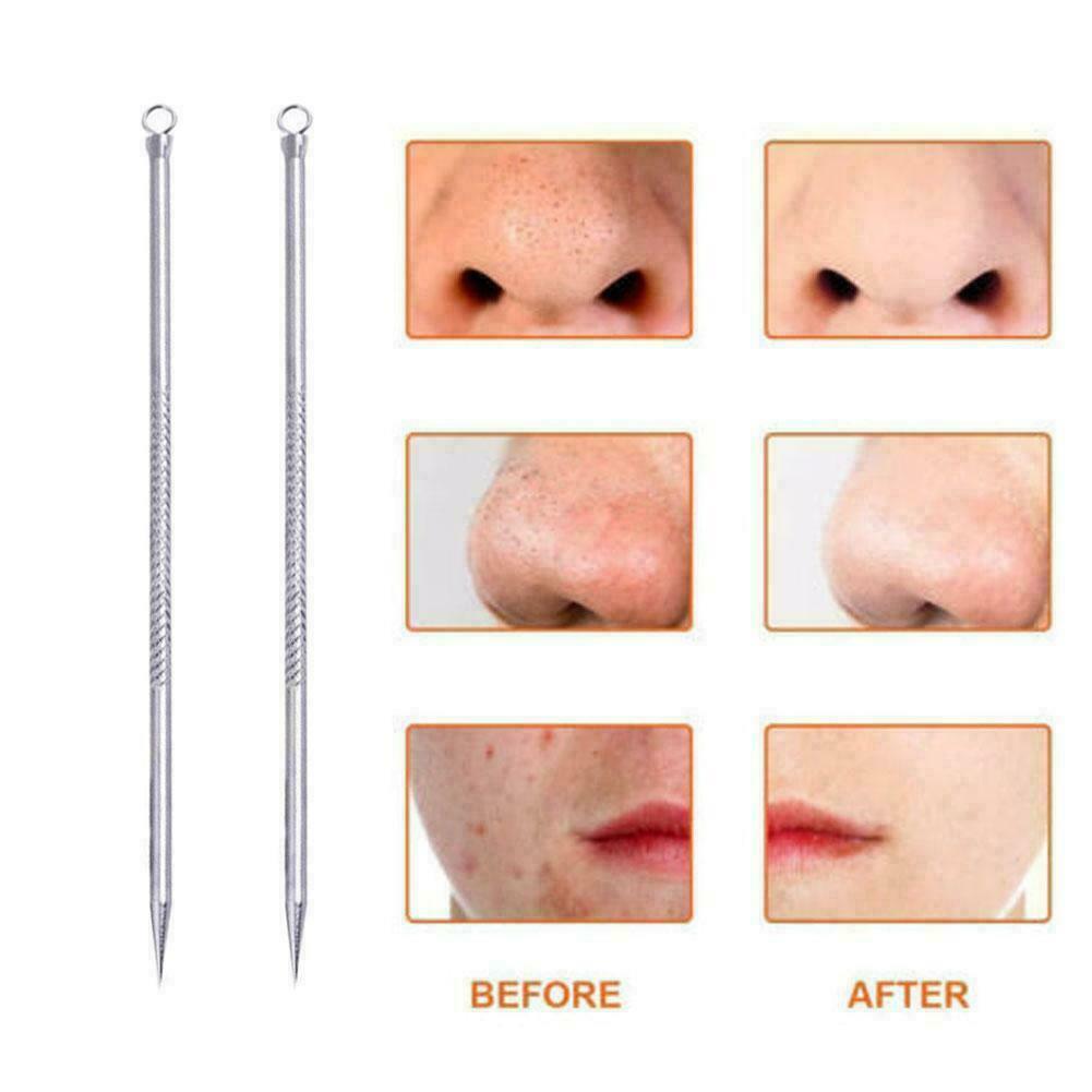 Carbon Steel Acne Needle Blackhead Removal Pin Pimple x Extractor 1 Tool X7K6