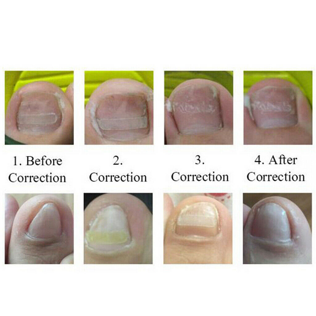 10x Ingrown Onyxis Toe Nail Correction Recover Pedicure Orthotic Tools