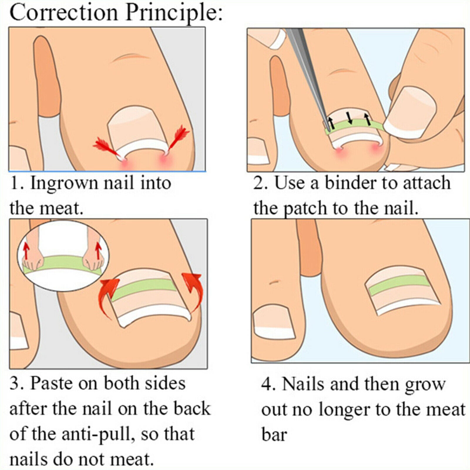 Professional Ingrown Toenail Corrections Kit Toenail Treatment Nail Glue Toenail