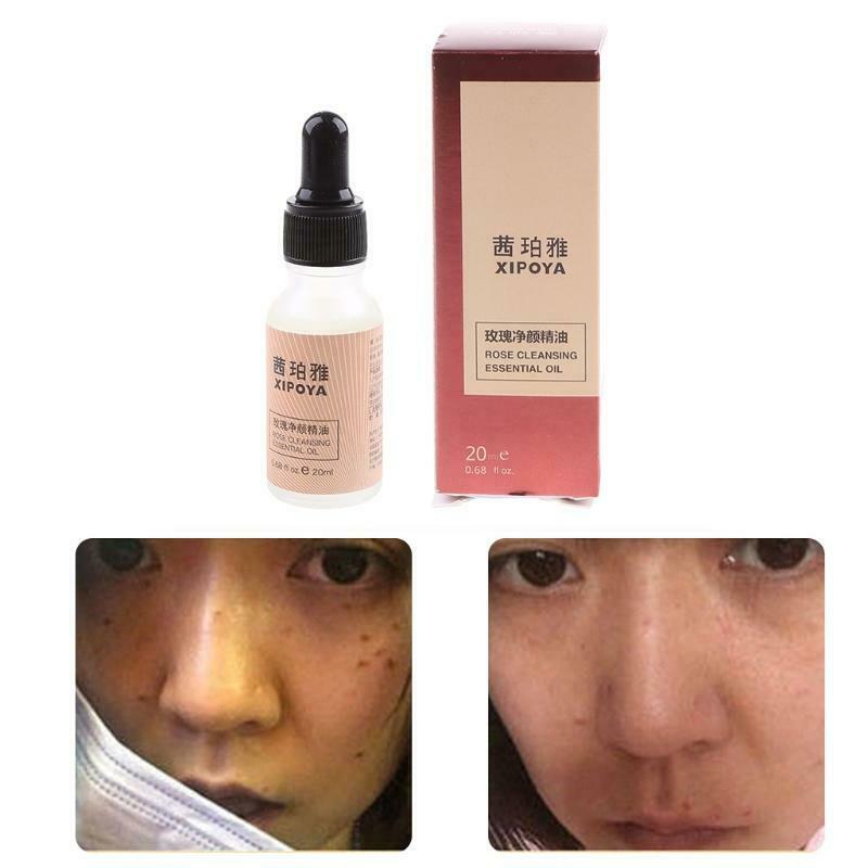 20ml Dark Spot Mole Repair Rose Essential Oil Skin Tag Freckle Painless Removal
