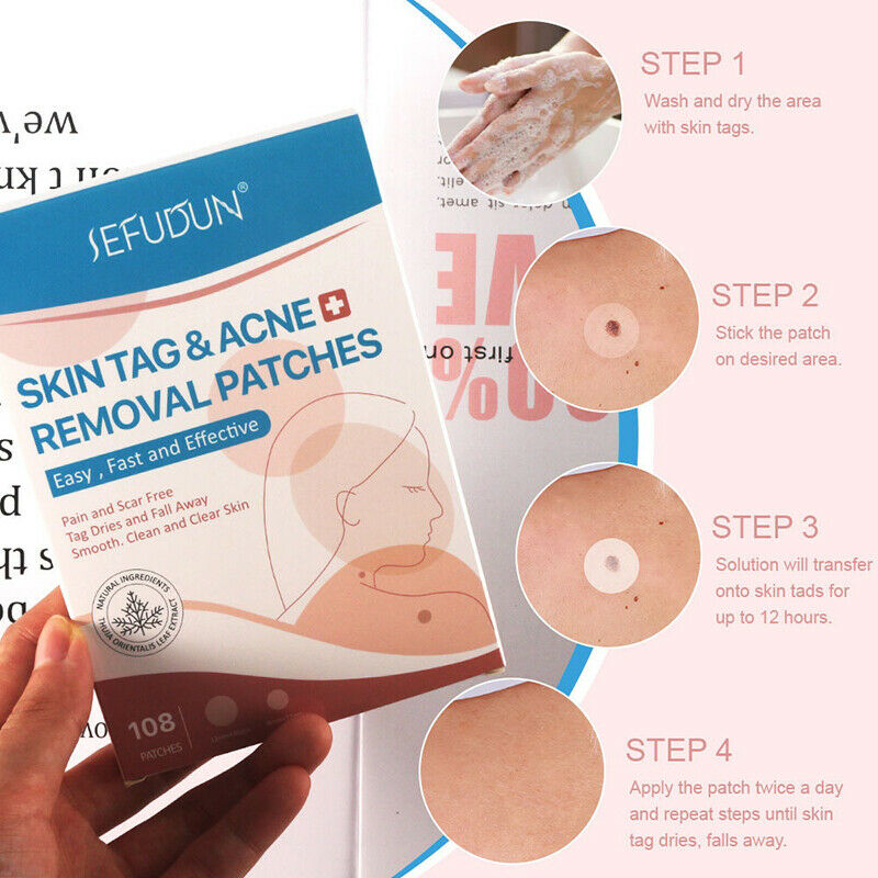 108pcs Skin Tag Remover Patch Hydrocolloid Acne Pimples Moles Zits WartsB CH SJ