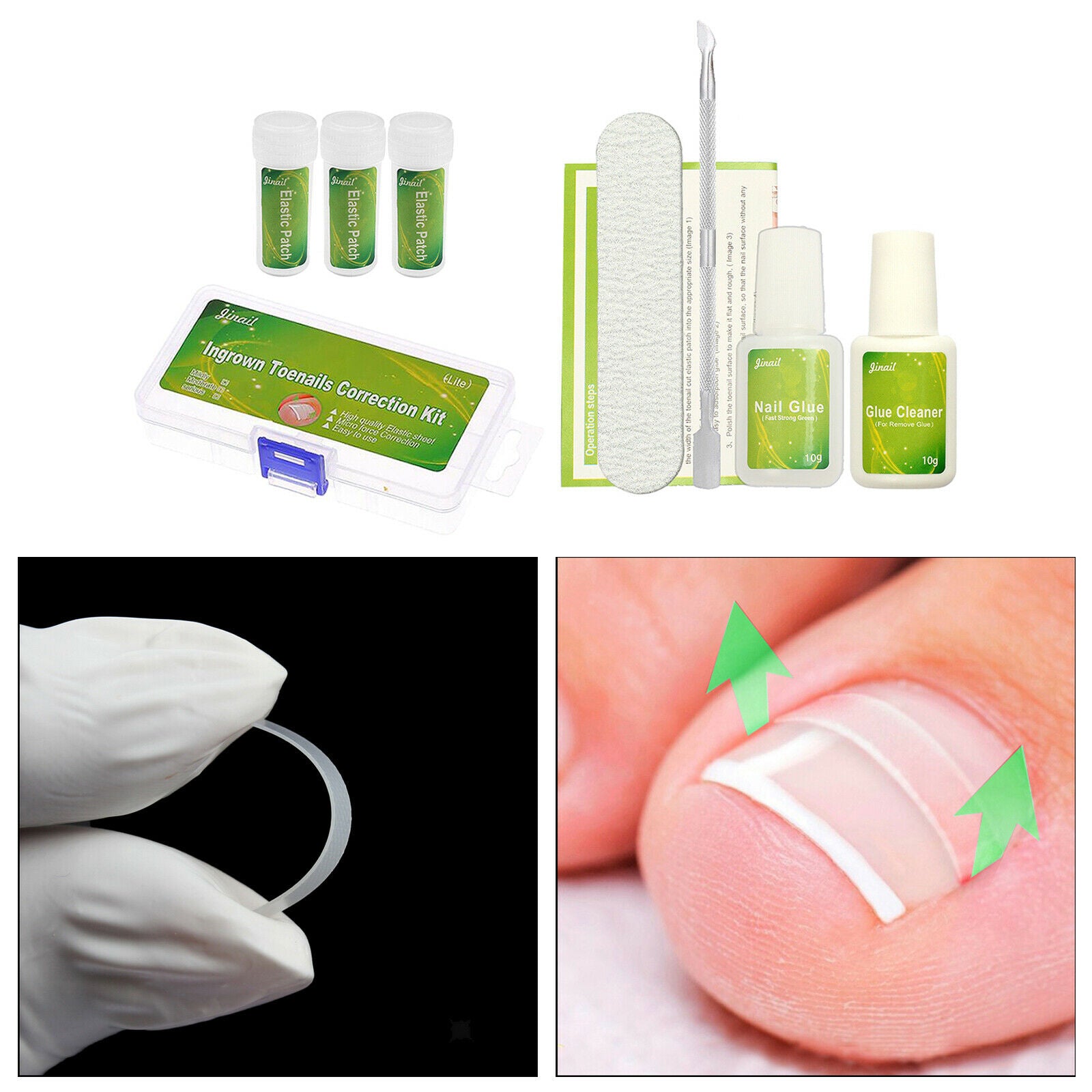 Professional Ingrown Toenail Corrections Kit Toenail Treatment Nail Glue Toenail