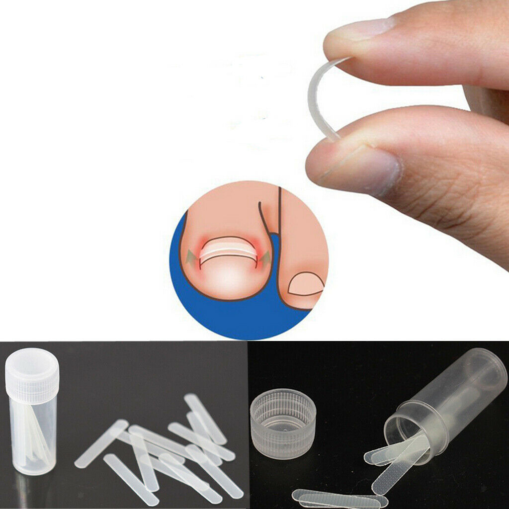 10x Ingrown Onyxis Toe Nail Correction Recover Pedicure Orthotic Tools