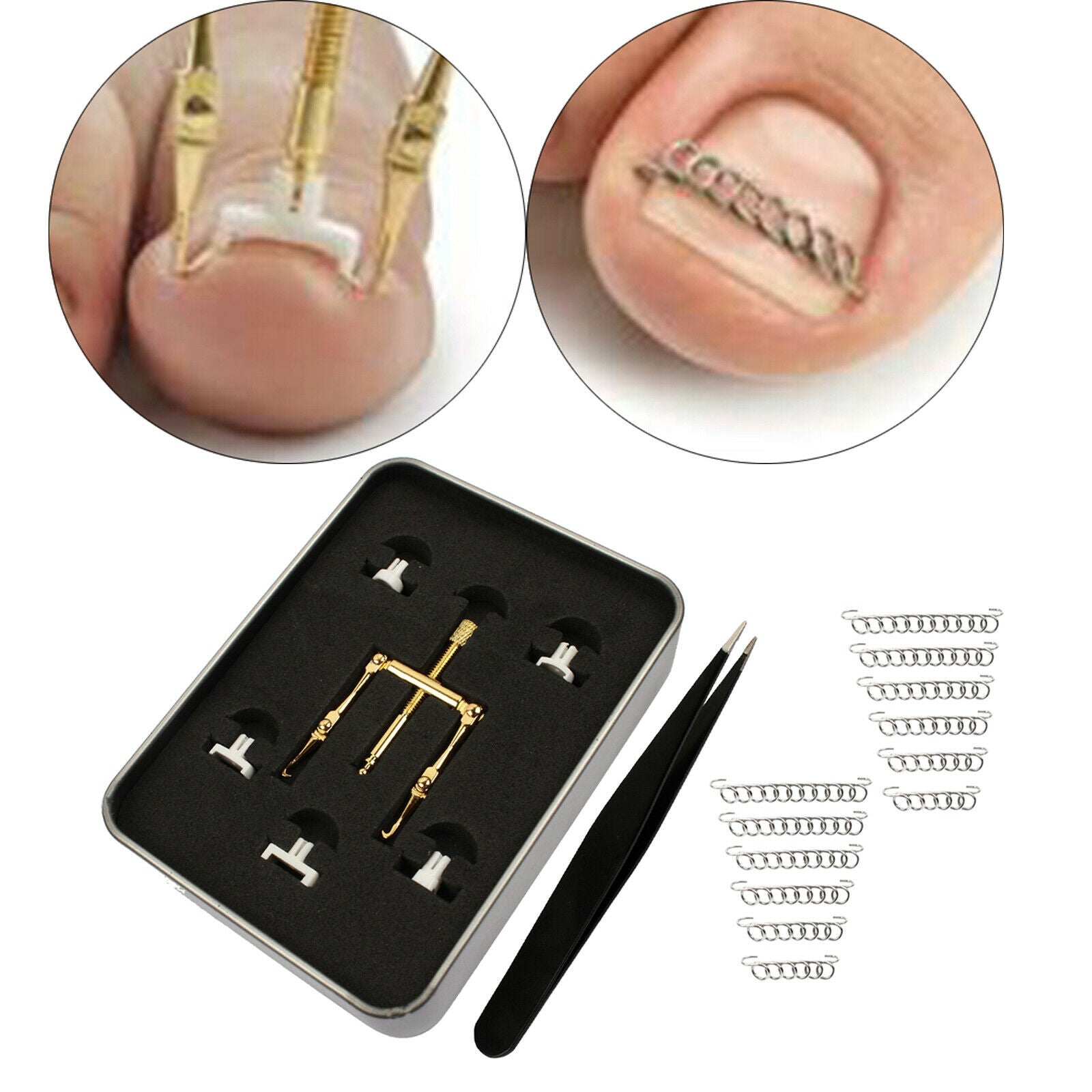 Portable Ingrown Toenail Correction Nail Lifter Clamp Foot Pedicure Tool