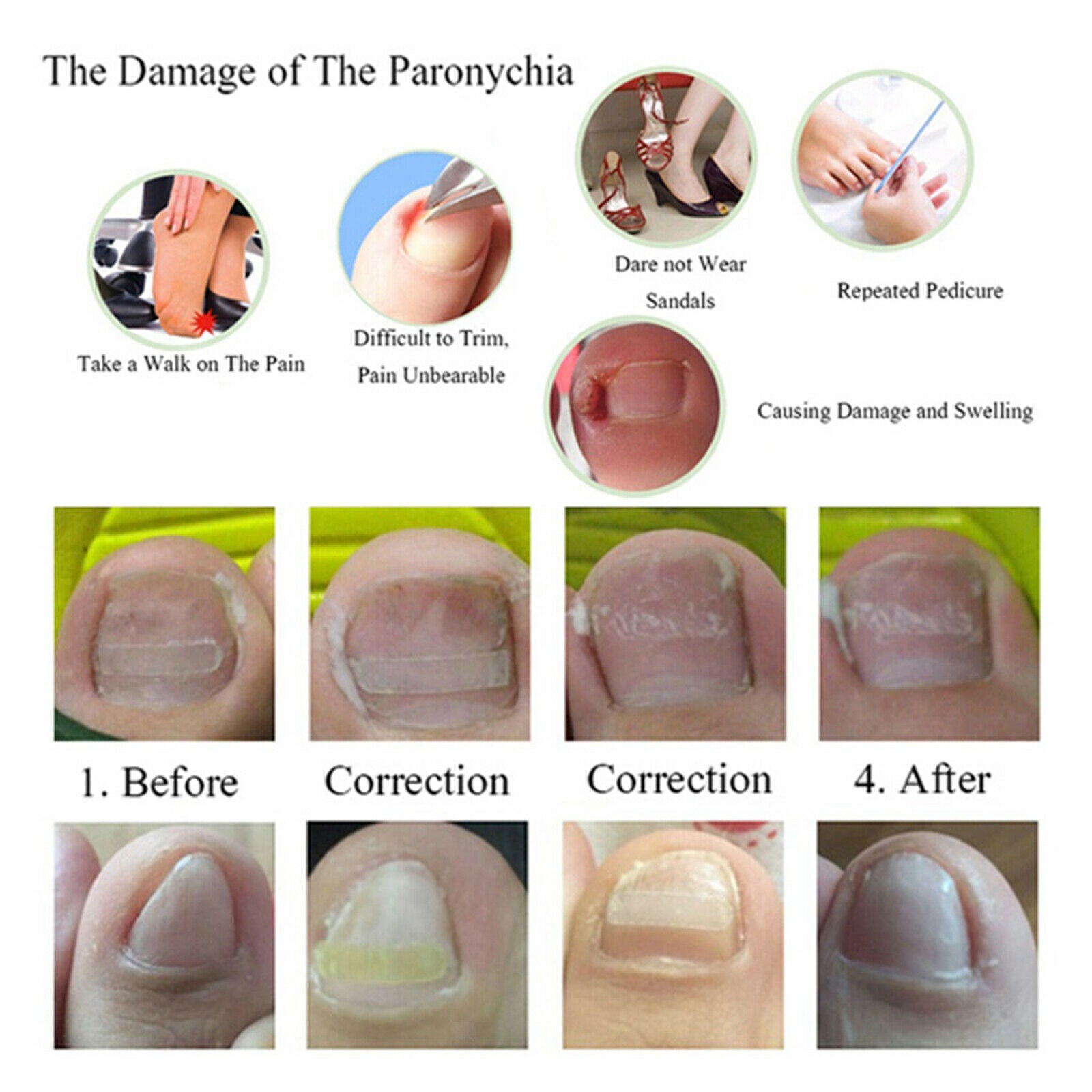 Professional Ingrown Toenail Corrections Kit Toenail Treatment Nail Glue Toenail
