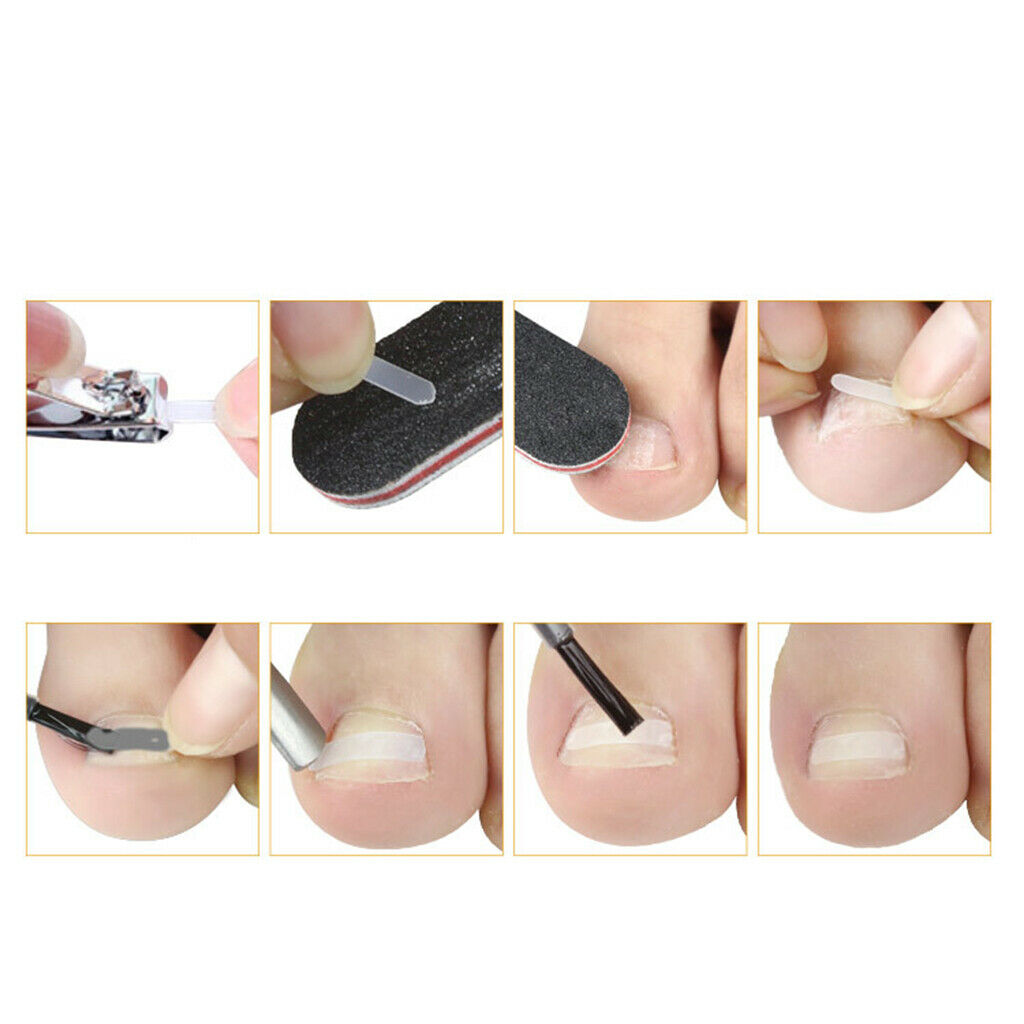 Strong Ingrown Toenail Set Supplies Tools for Nail Correction Men Women