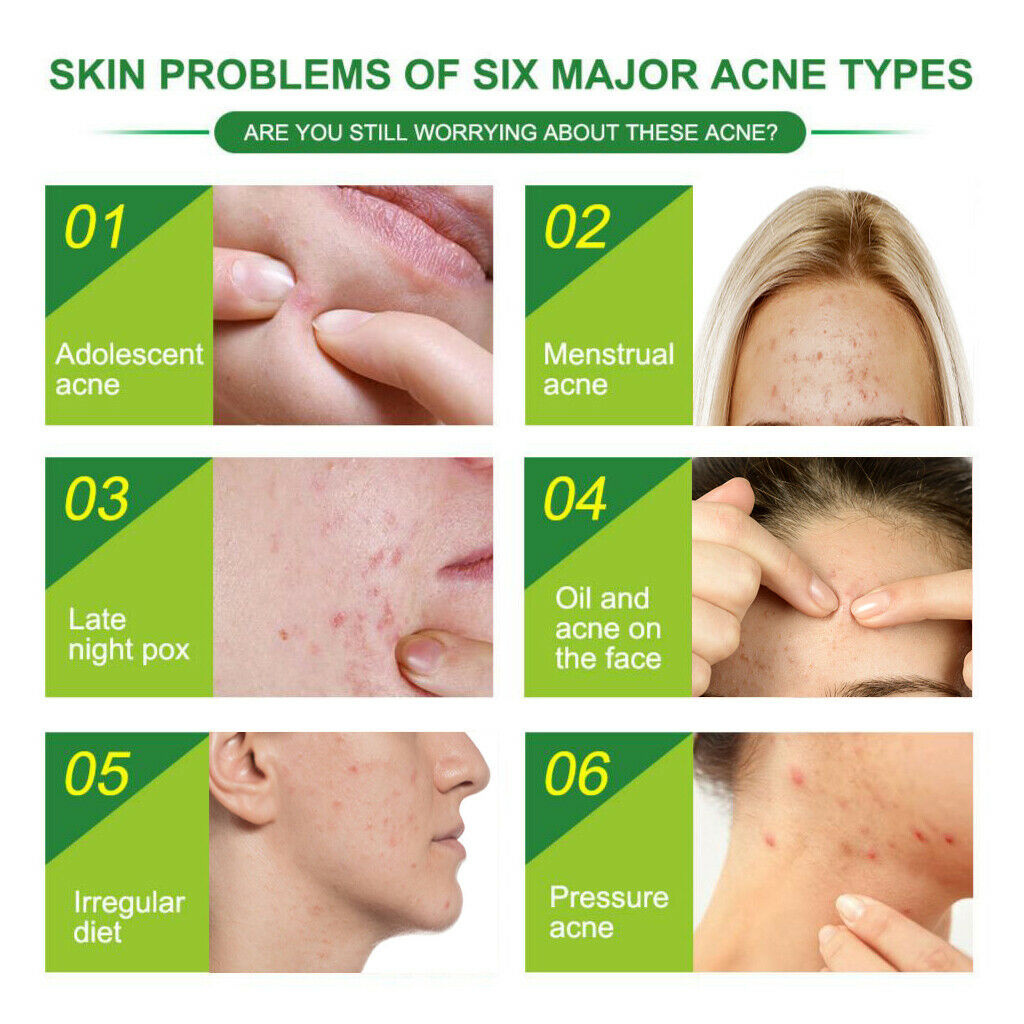 24 Pieces Acne Pimple Spot Patch Removal Clear Facial Spot Face Skin Care
