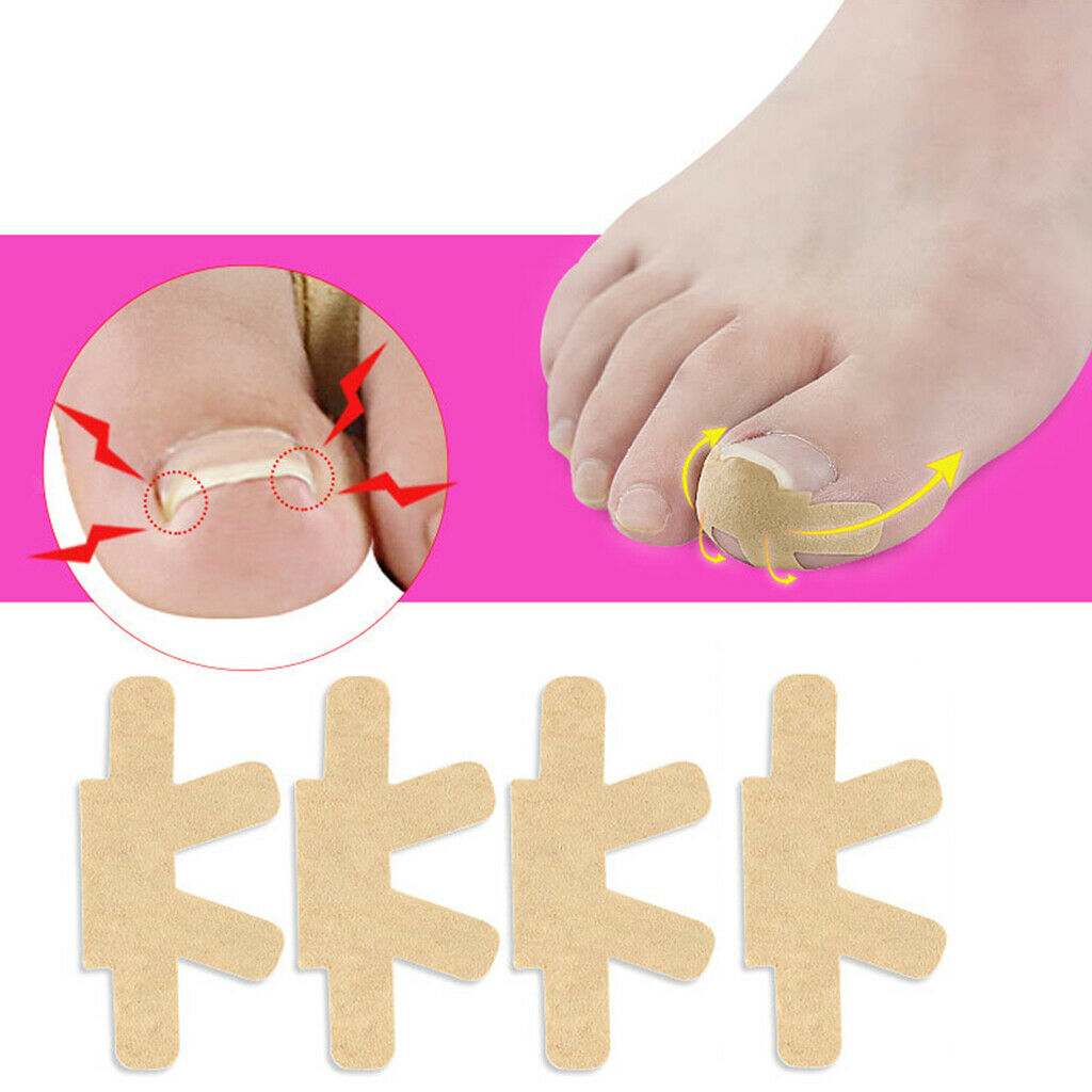 Pack 4 Ingrown Toenail Corrector Toenail Patch Glue free for Men Women