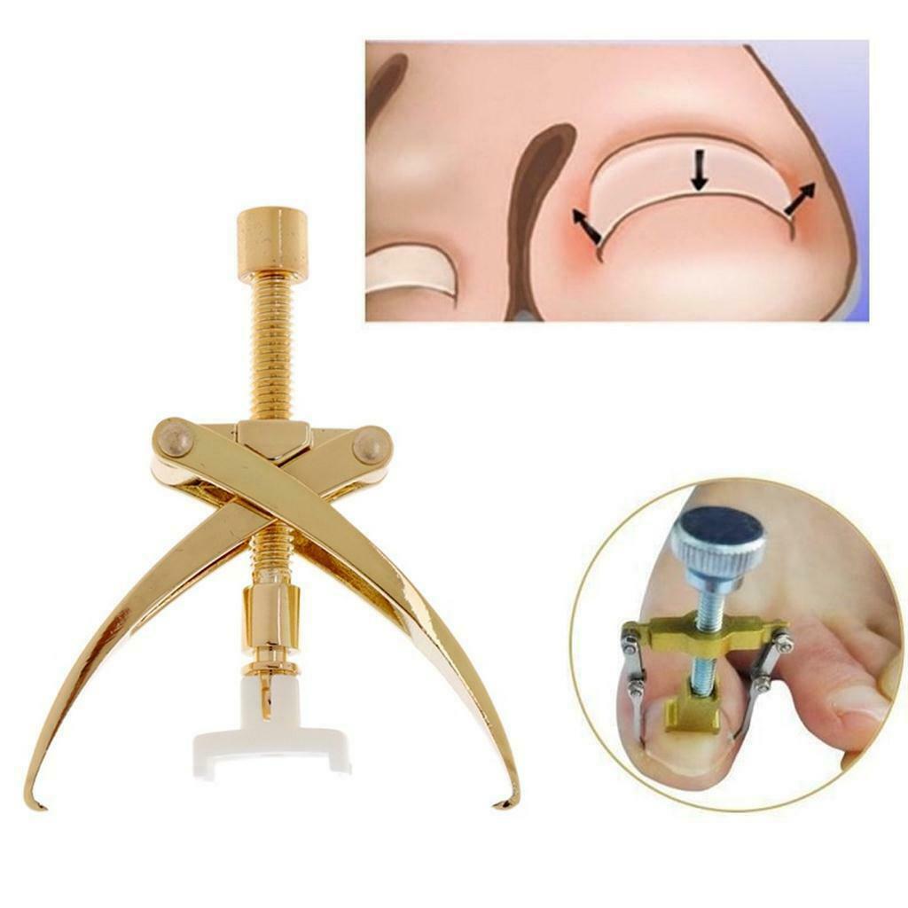 Ingrown Toenail Correction Braces Kit Professional