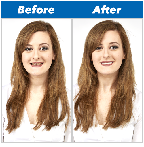 Tooth Replacement Perfect Smile Reusable Removable Installation Instant - New