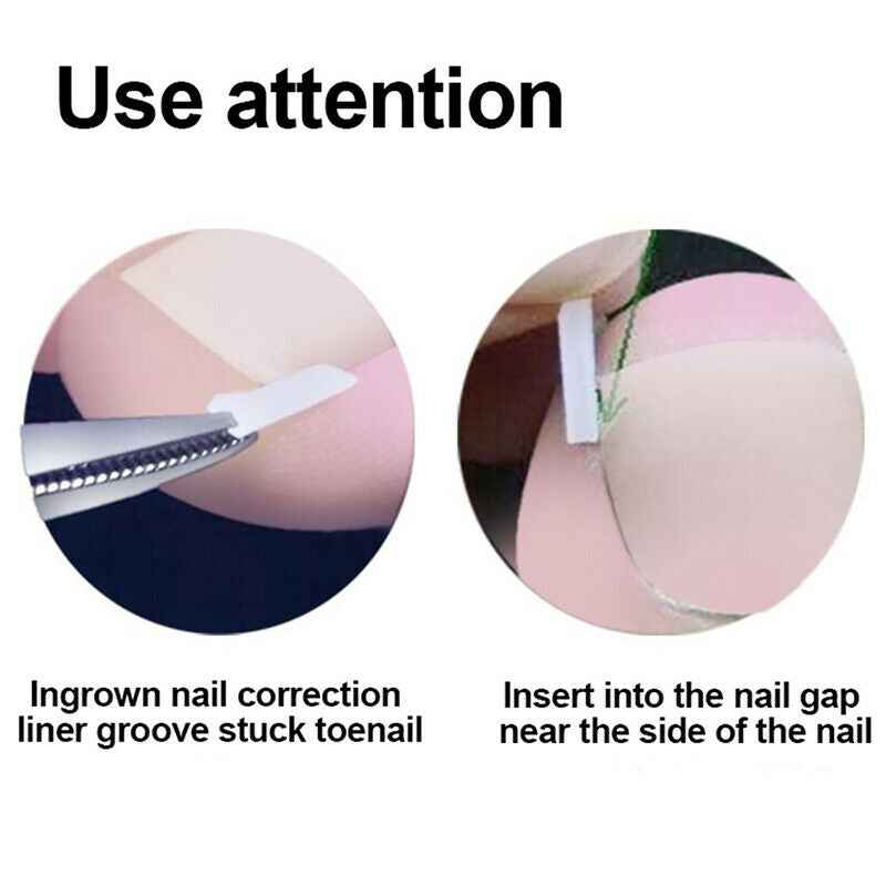 3Pcs Ingrown Nails Straightening Clip Toenail Correction Pad Pedicure Nail CD BD