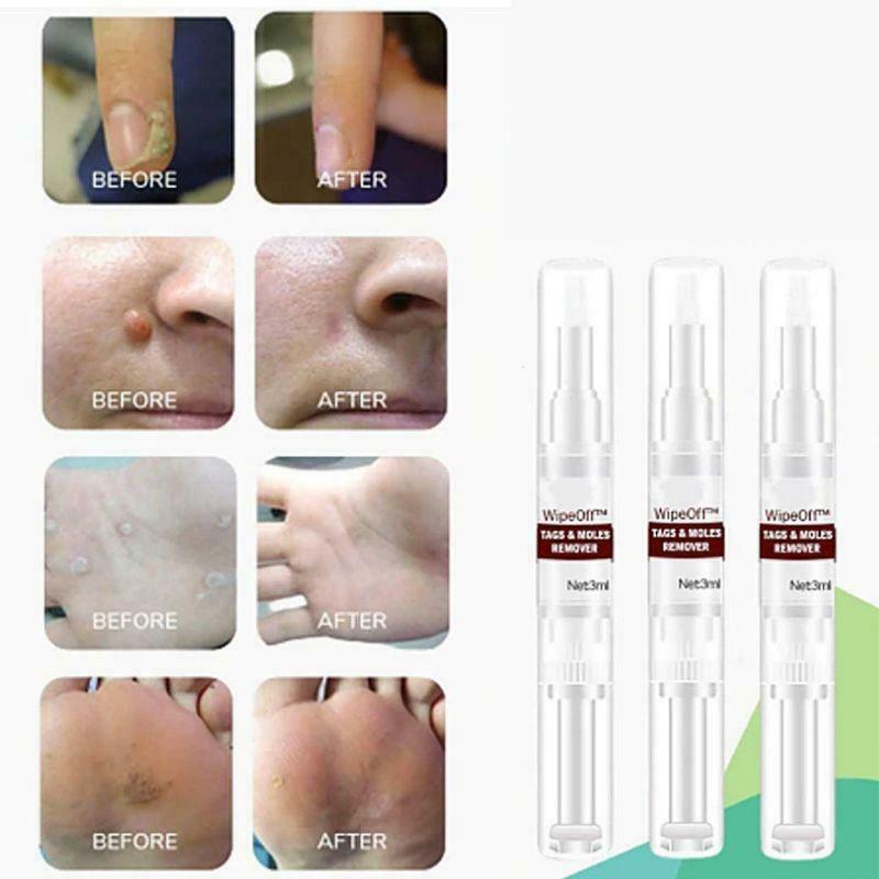 10ml Skin Tags Moles Remover Pen Facial Body Wart Dark Spot Treatment Liquid