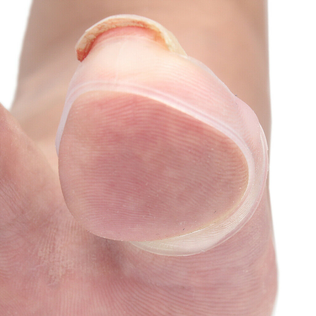 Silicone Ingrown Toe Nail Correction Sleeves Cover Paronychia Straightener