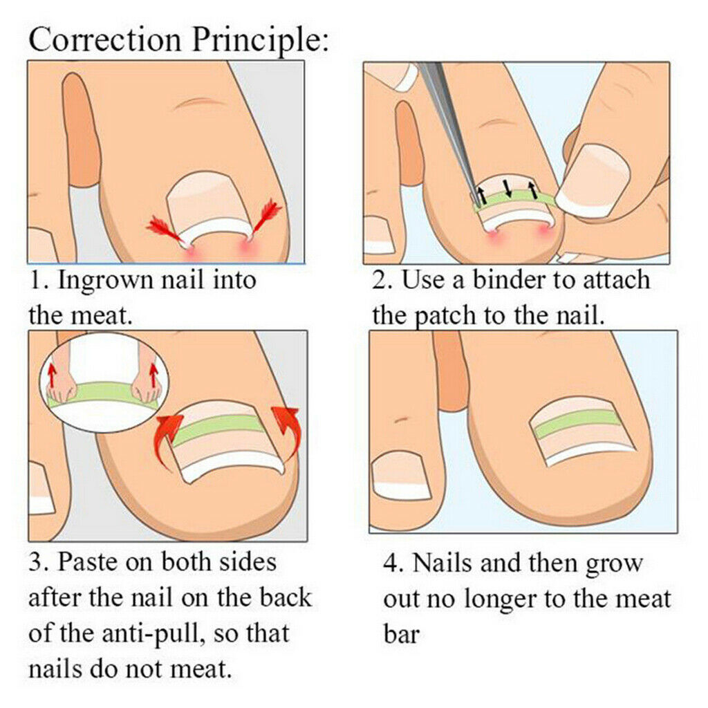 10Pcs Ingrown Corrector Toe Nail Corrector Straightener Paronychia Pedicure Tape