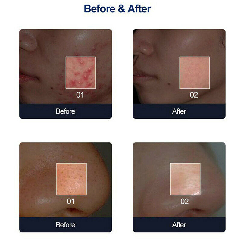 Dermabrasion Tip Diamond Microdermabrasion Dermabrasion Replacement Beauty To SJ