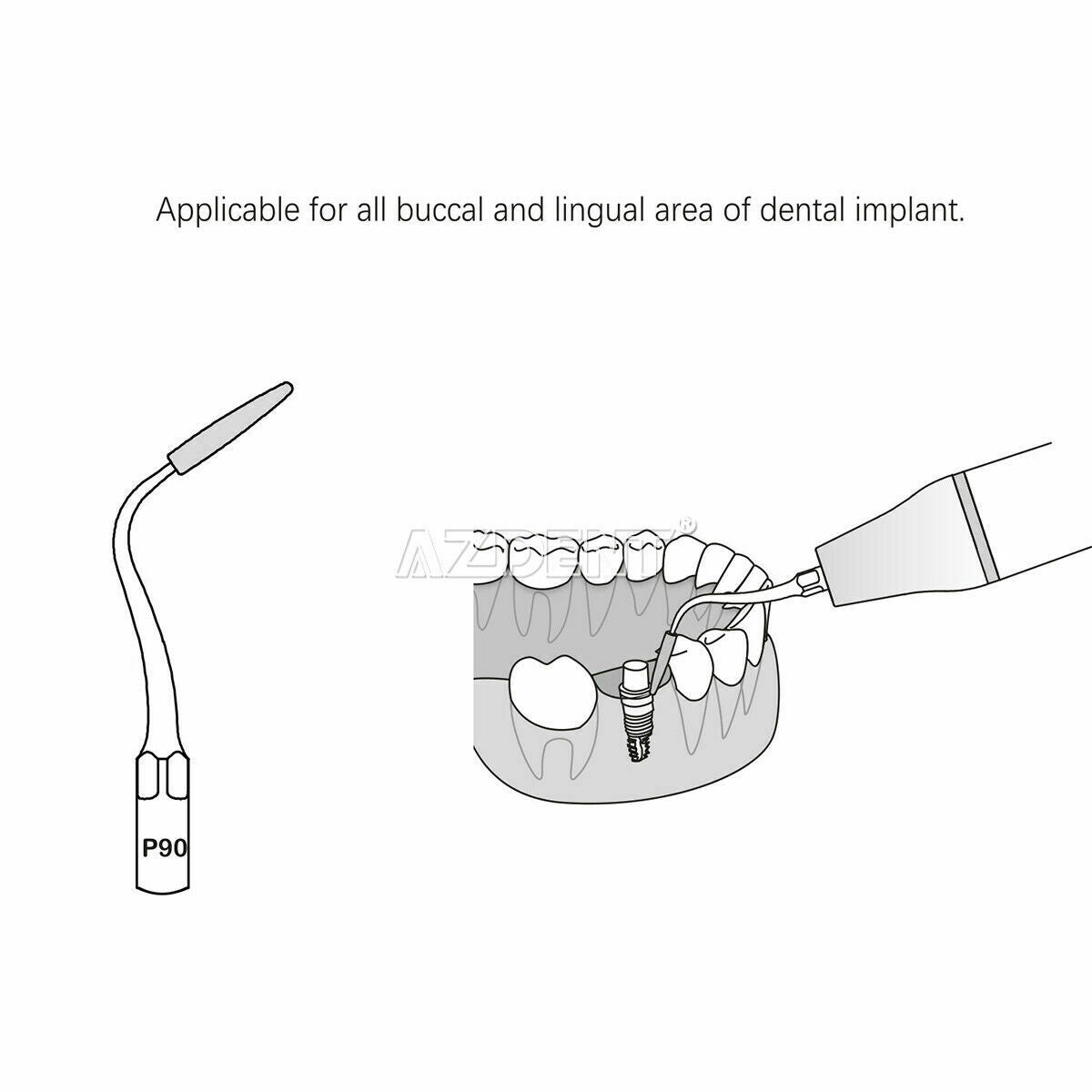 5 X Dental Scaler Tip Periodontal Implant Cleaning Tip P90  Fit EMS WOODPECKER