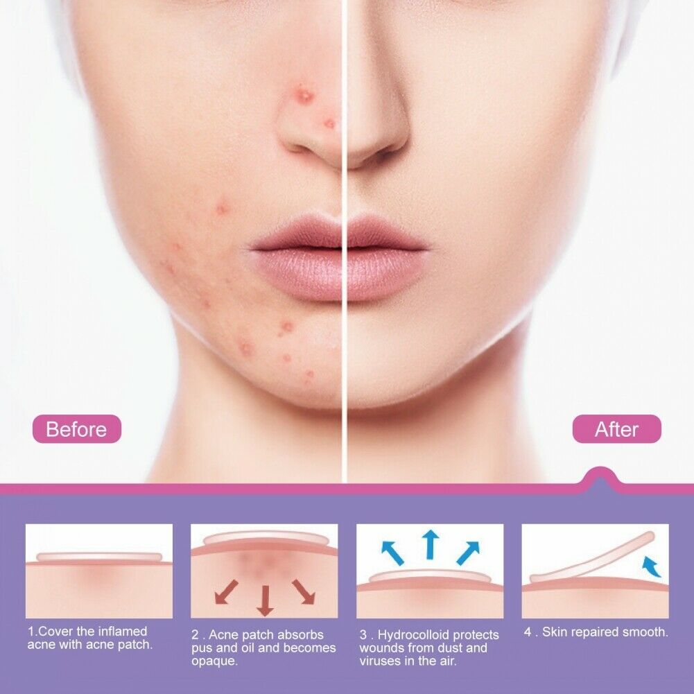24Pcs/Sheet Invisible Acne Patches Anti-Acne Colloidal Acne-Covering Patch
