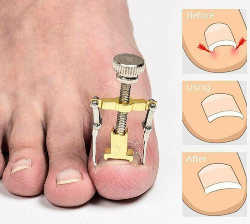 Ingrown Toe foot Nail Correction Fixer Nail Pedicure Tool Toenail Corrector US