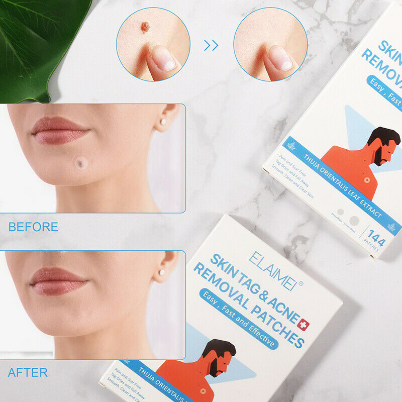 144PCS Skin Tag Acne Patch Hydrocolloid Acne Skin Tag Invisible Remover Patc SJ