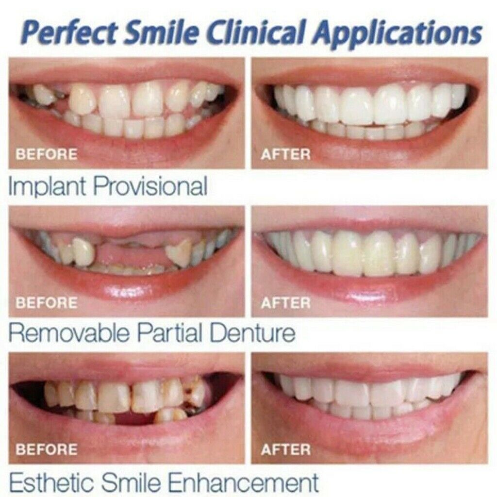 1Pcs Soft Silicone Top Upper Cosmetic Teeth Cover Veneers Instant Smile