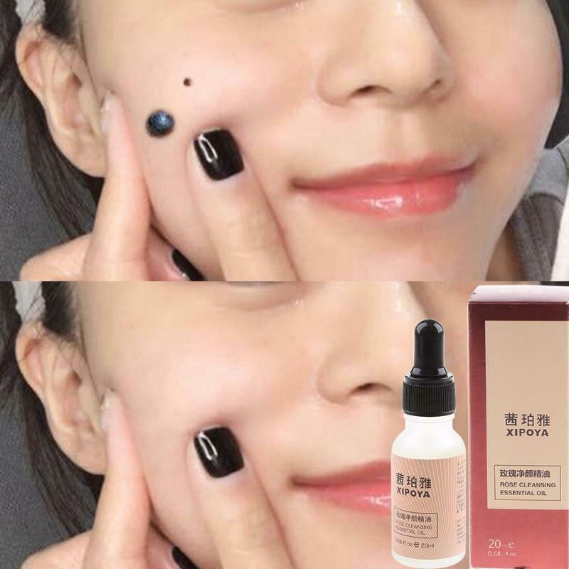 20ml Dark Spot Mole Repair Rose Essential Oil Skin Tag Freckle Painless Removal