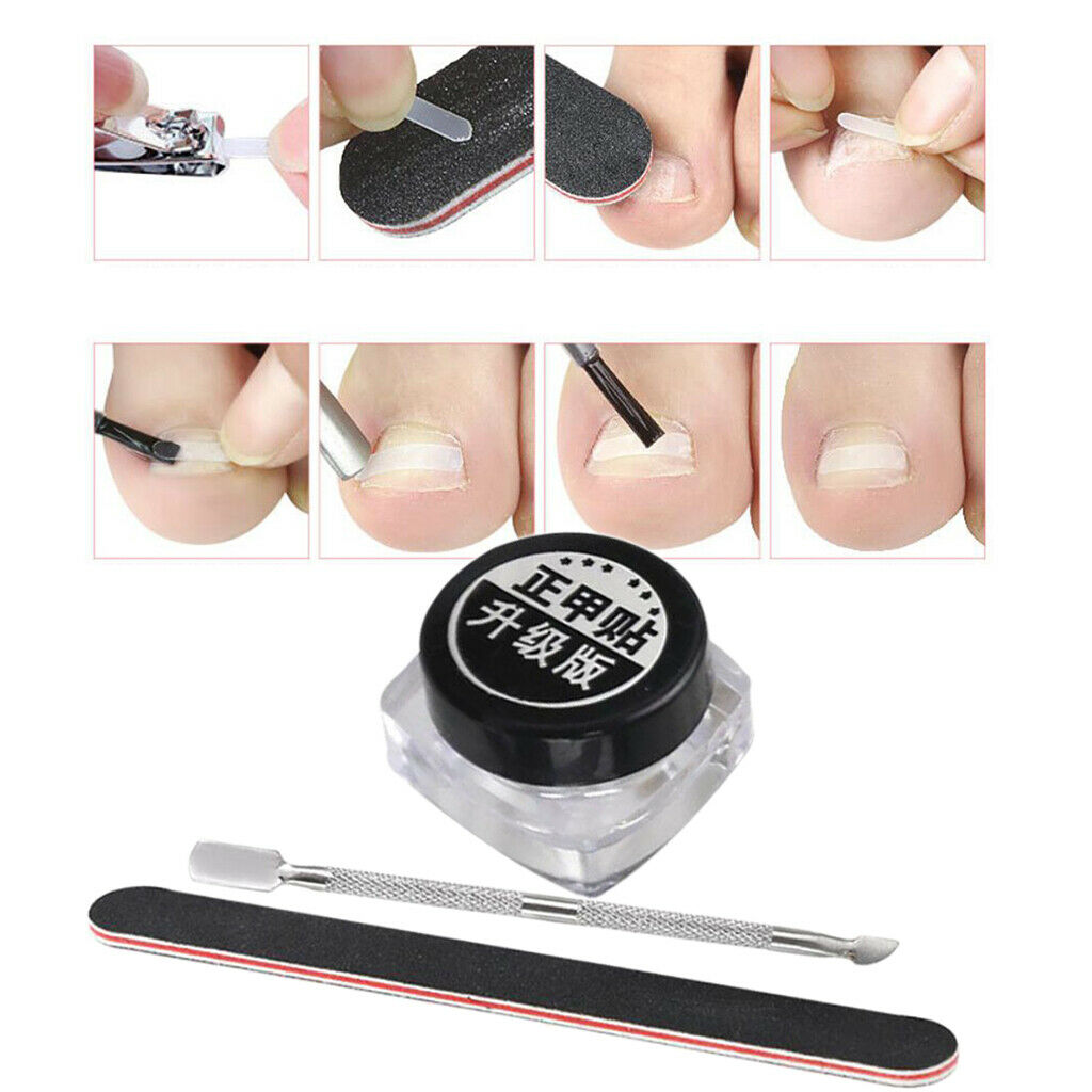 Ingrown Toenail Corrector Patch Brace Treatment