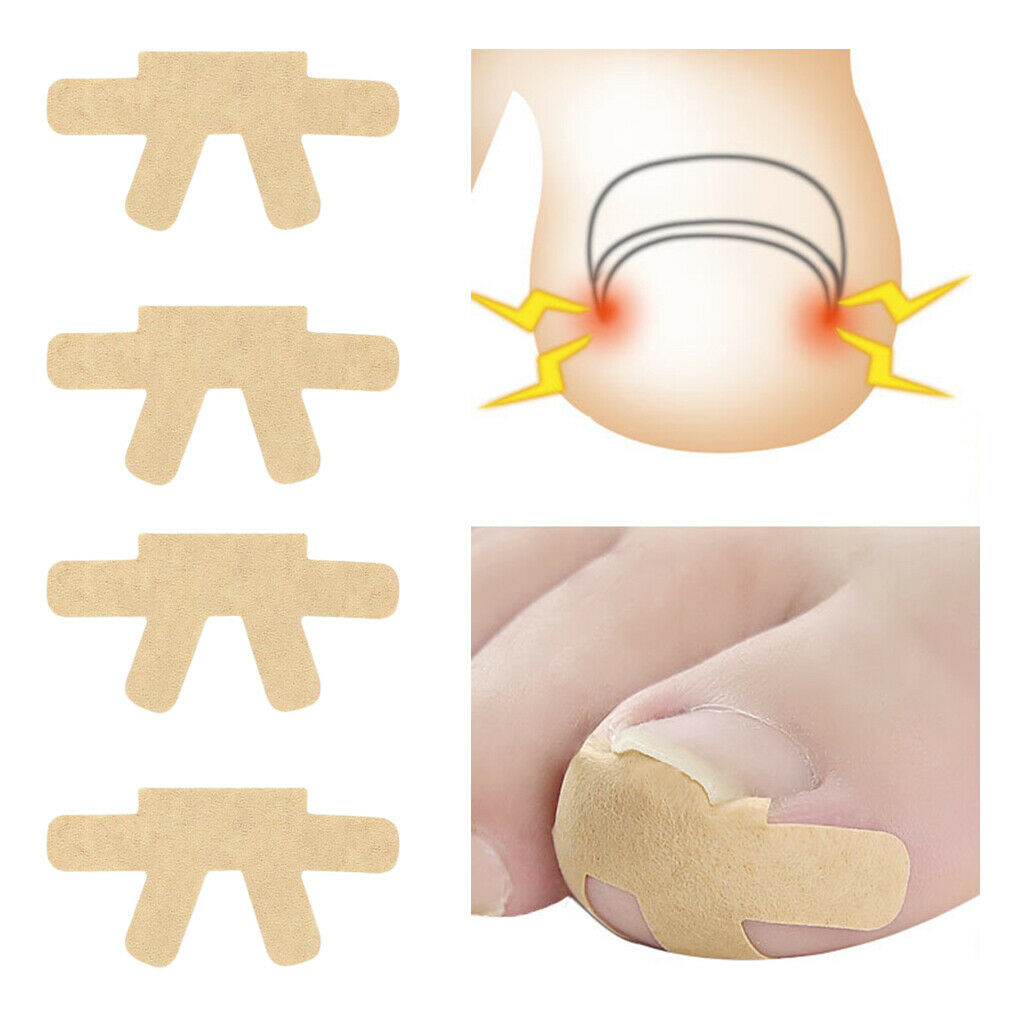 Pack 4 Ingrown Toenail Corrector Toenail Patch Glue free for Men Women