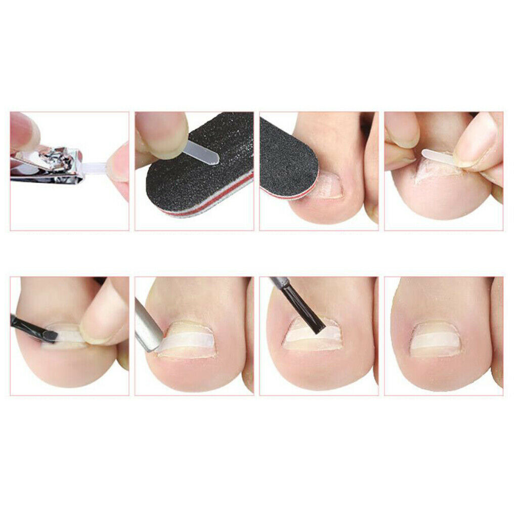 Ingrown Toenail Corrector Patch Brace Treatment