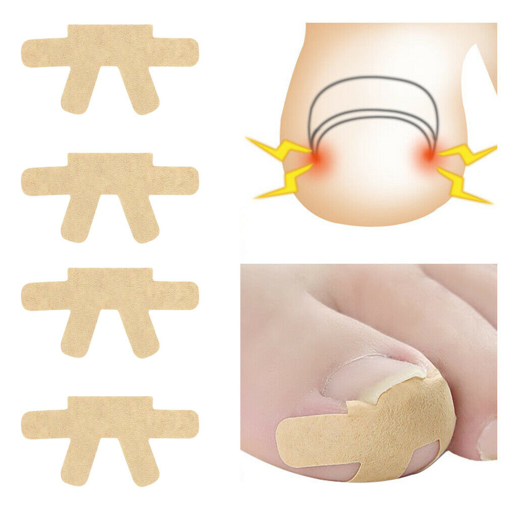 4pcs Elastic Ingrown Toenail Corrector Strips Treatment Toenail Patch Brace