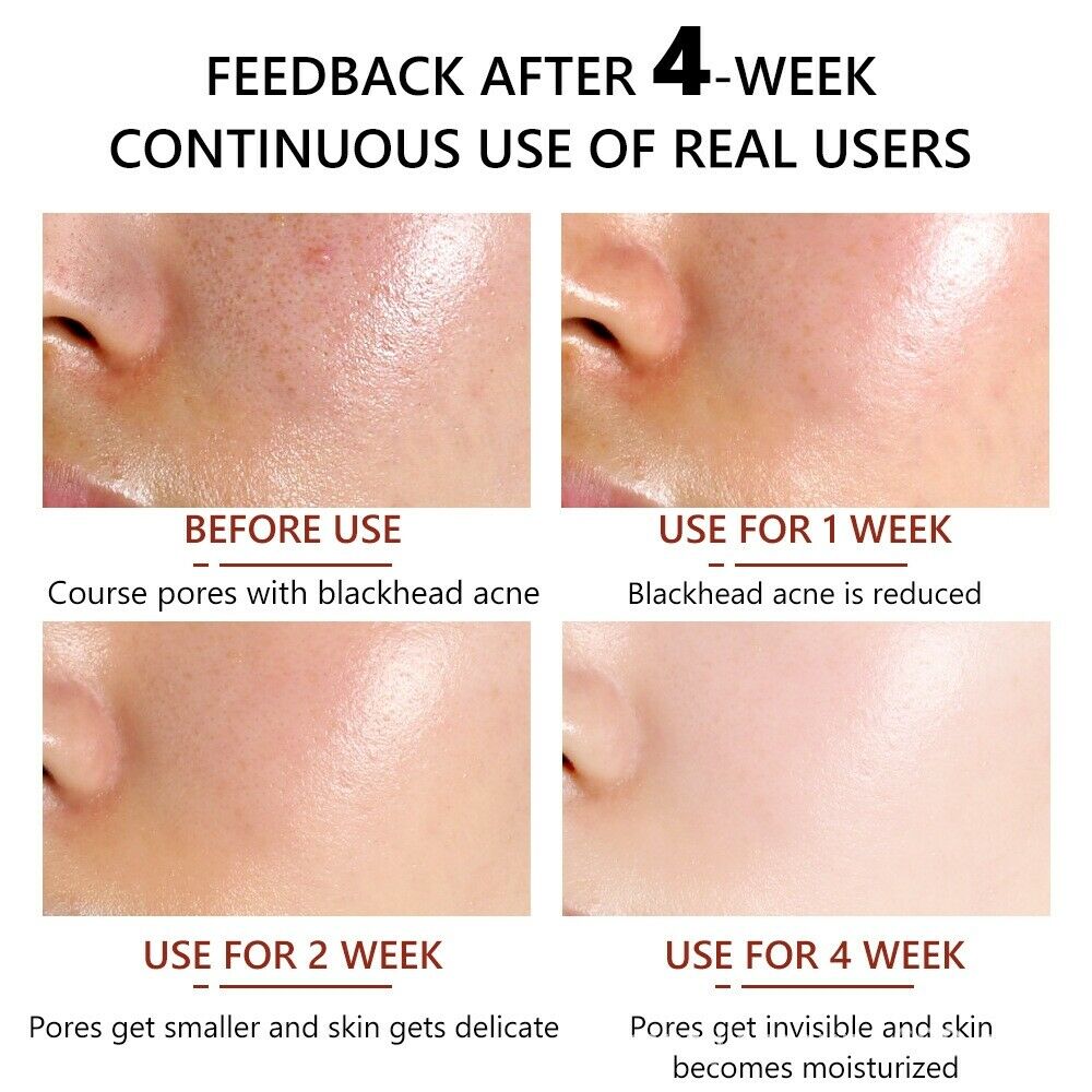 30ml Moisturizing Remove Acne facial Care Shrink Pore Minimizer Serum Salicylic