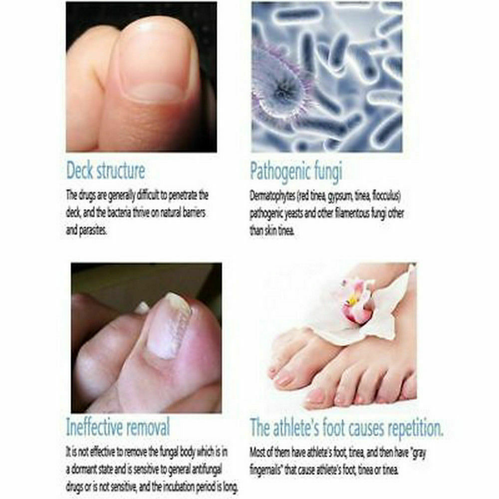 3ml Anti Fungal Nail Treatment Liquid Toes Nail Finger Fungus Onychomycosis Care