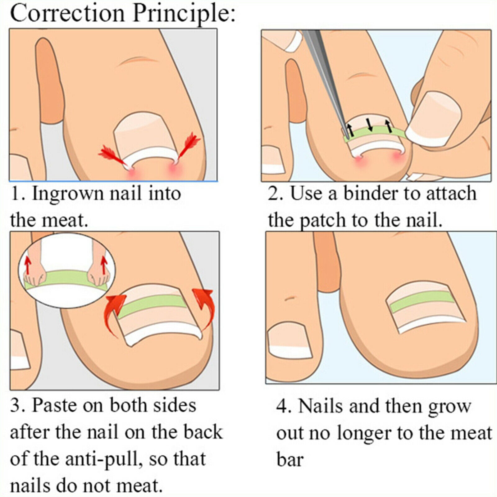 Ingrown Toenail Correction Tool Ingrown Toe Nail Pedicure Patch Straightening