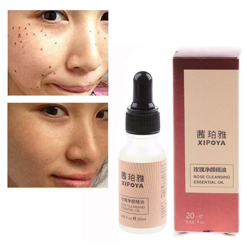 20ml Dark Spot Mole Repair Rose Essential Oil Skin Tag Freckle Painless Removal