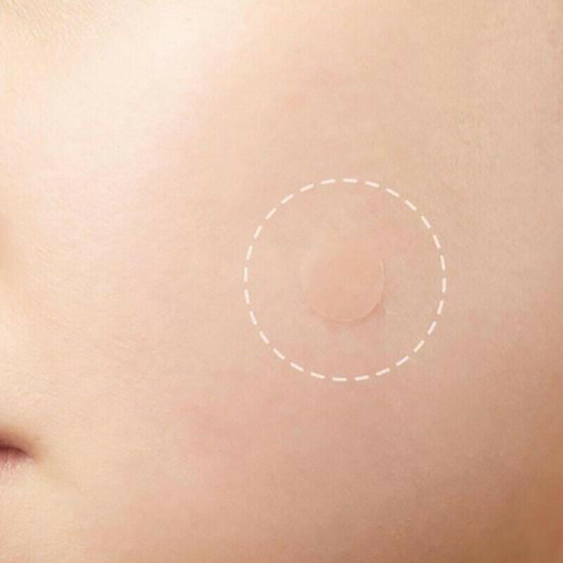 36Pcs Skin Tag & Acne Patch Hydrocolloid Acne and Skin Tag Remover Patch.l8