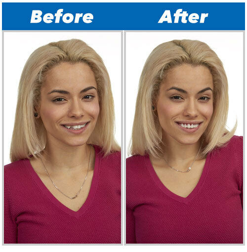 Tooth Replacement Perfect Smile Reusable Removable Installation Instant - New