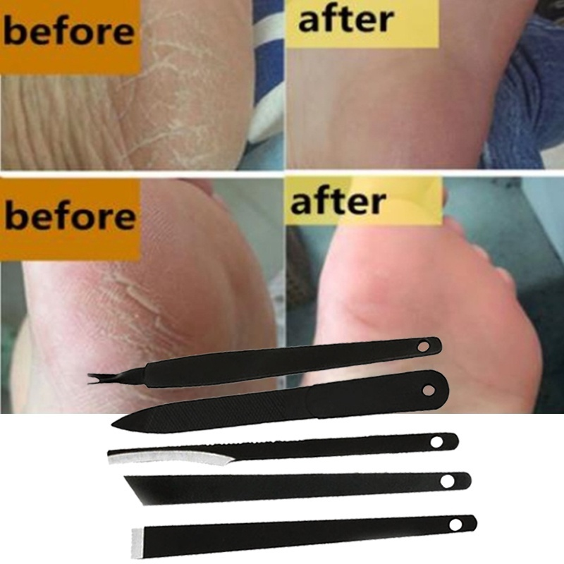 5* Foot Rasp File Callus Remover Hard Dead Skin Removal Scrubber Pedicure Tool