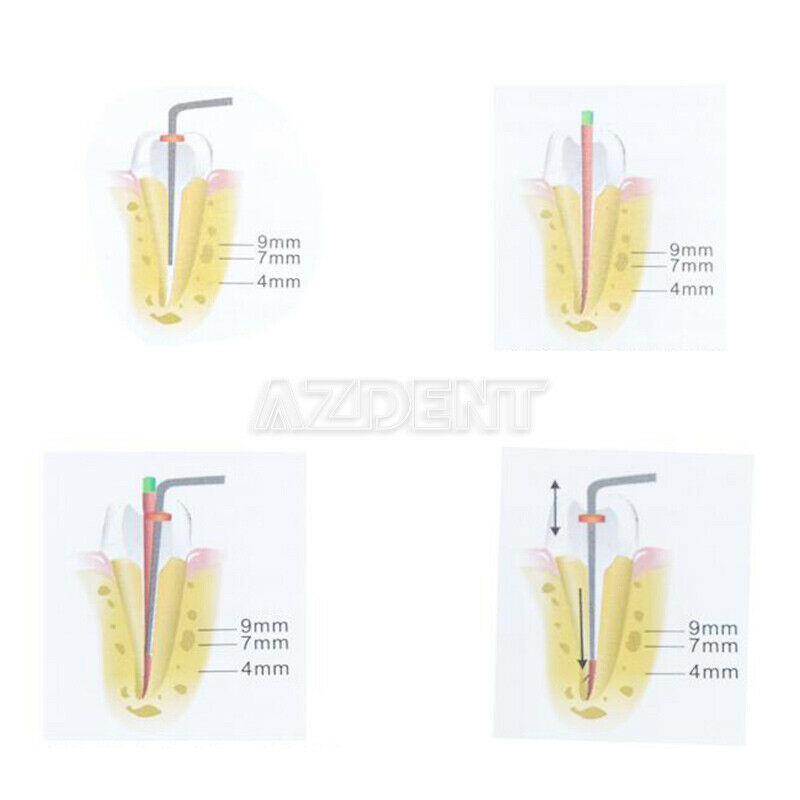 2X Dental Cordless Gutta Percha Obturation System Endo Heated Pen J1SS+ Tips