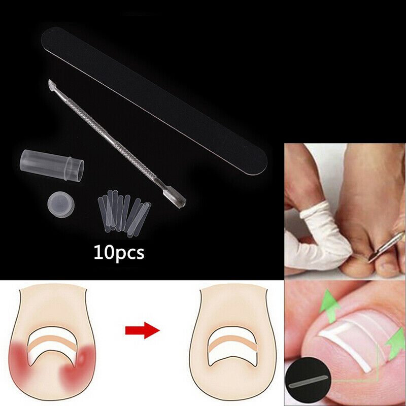 Ingrown Toe Nail Correction Kit Toenail Treatment Nail Pusher Recover Foot C BU