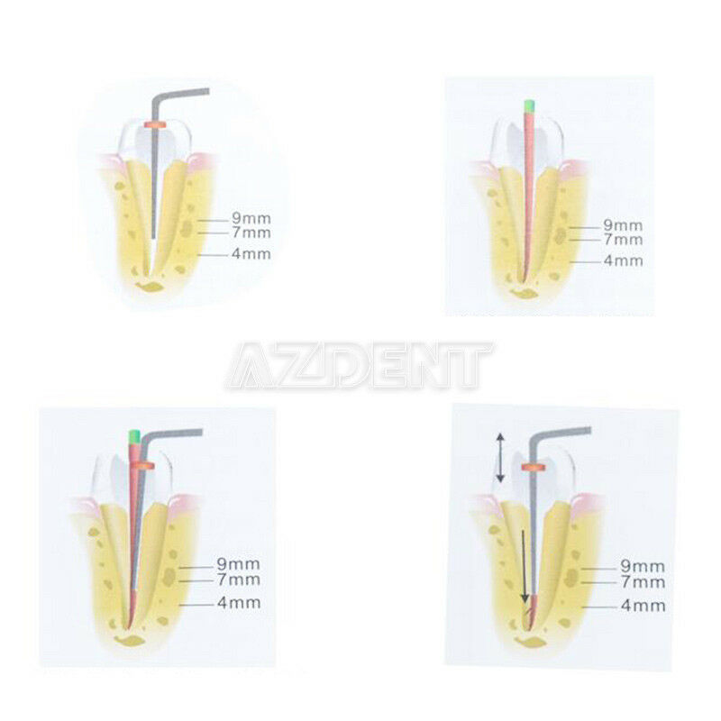 Dental Cordless Obturation System Gutta Percha Endo Heated Pen 4 Tips